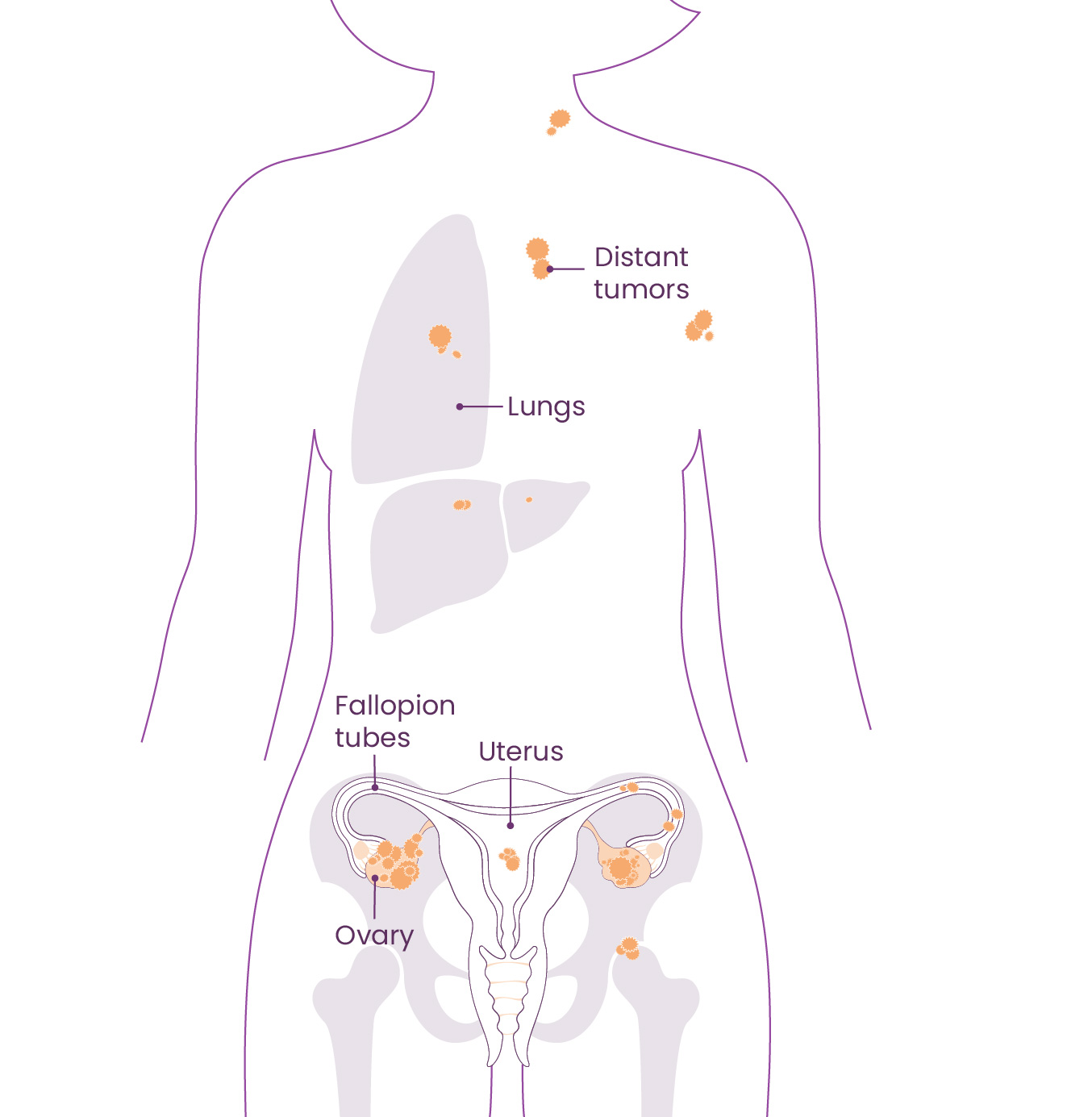 Anatomical diagram identifying the locations of the body impacted based on FIGO staging