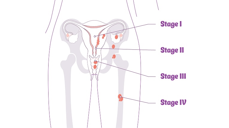 Anatomical diagram of the different stages of endometrial cancer